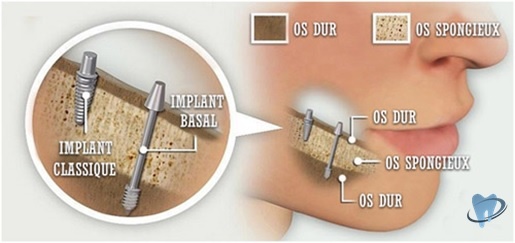 implant dentaire basal Tourident