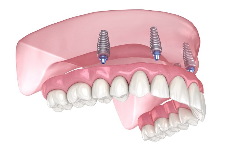 refaire ses dents implant complet
